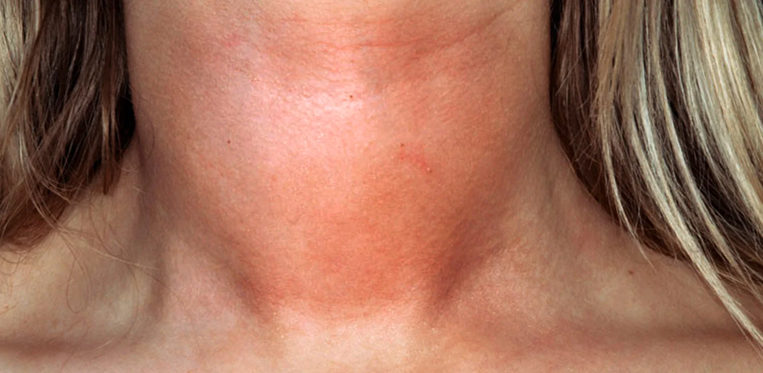 Hypothyroidism and the Role of Homeopathy